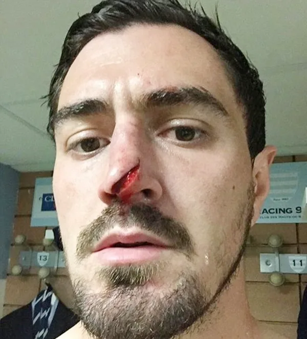 330E613200000578-3533655-Alexandre_Dumoulin_posted_this_picture_of_his_gory_injury_picked-a-33_1460368370884.jpg